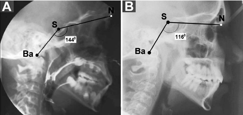 FIGURE 2 Cephalometric radiographs and tracings illustrating Ba-S-N angular variations. Radiographs of a platybasic individual (A) demonstrating an obtuse cranial-base angle (1448) and radiographs of a nonplatybasic patient (B) demonstrating a more acute cranial-base angle (1168). Ba-S-N reference points indicate the cranial-base angle; S-N, anterior cranial base; Ba-S, posterior cranial base. Ba basion; S sella; N nasion.