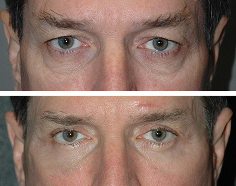 male-eyelid-surgery-patient-photos.jpg