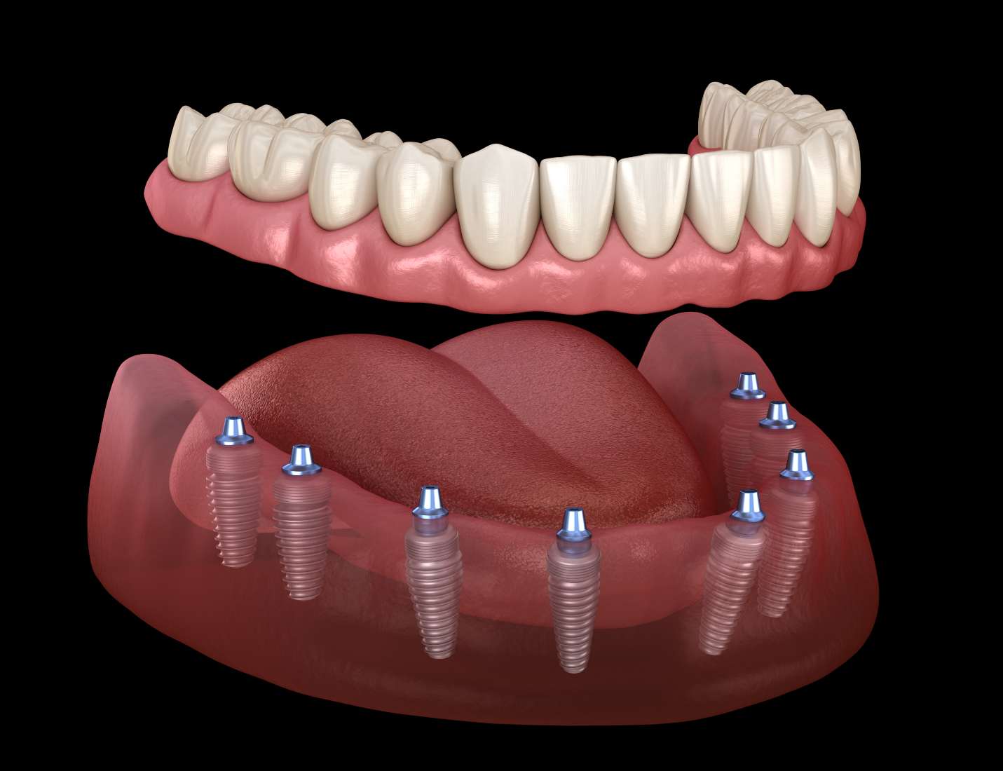 all-on-8-dental-implants.jpg