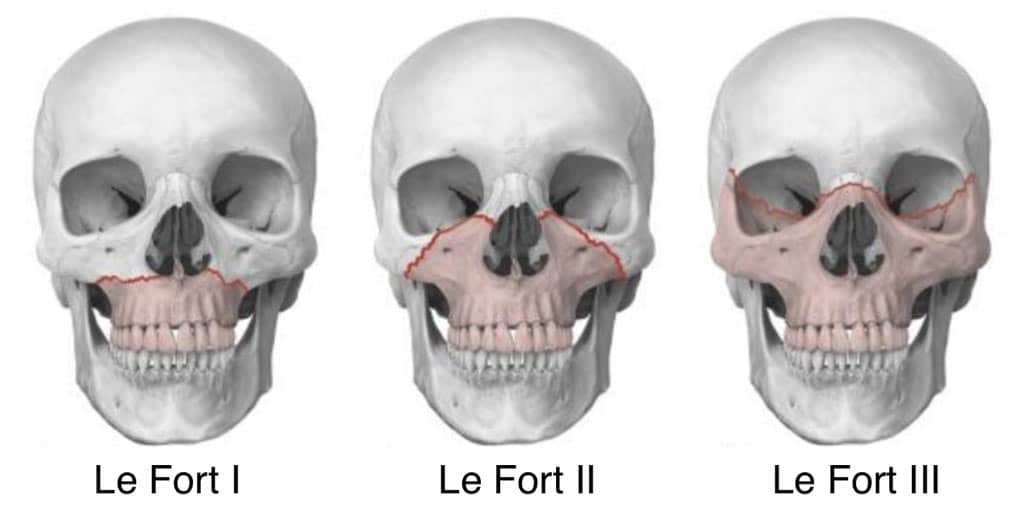 LeFort-Fractures-1-2-3.jpg