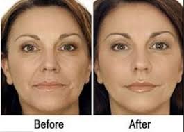 Image result for microcurrent facial before after