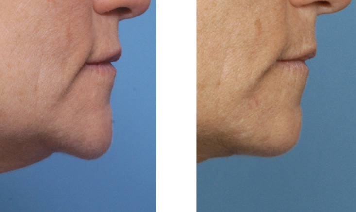 Chin-Pad-Ptosis-Excision-result-side-view-Dr-Barry-Eppley-Indianapolis.jpg