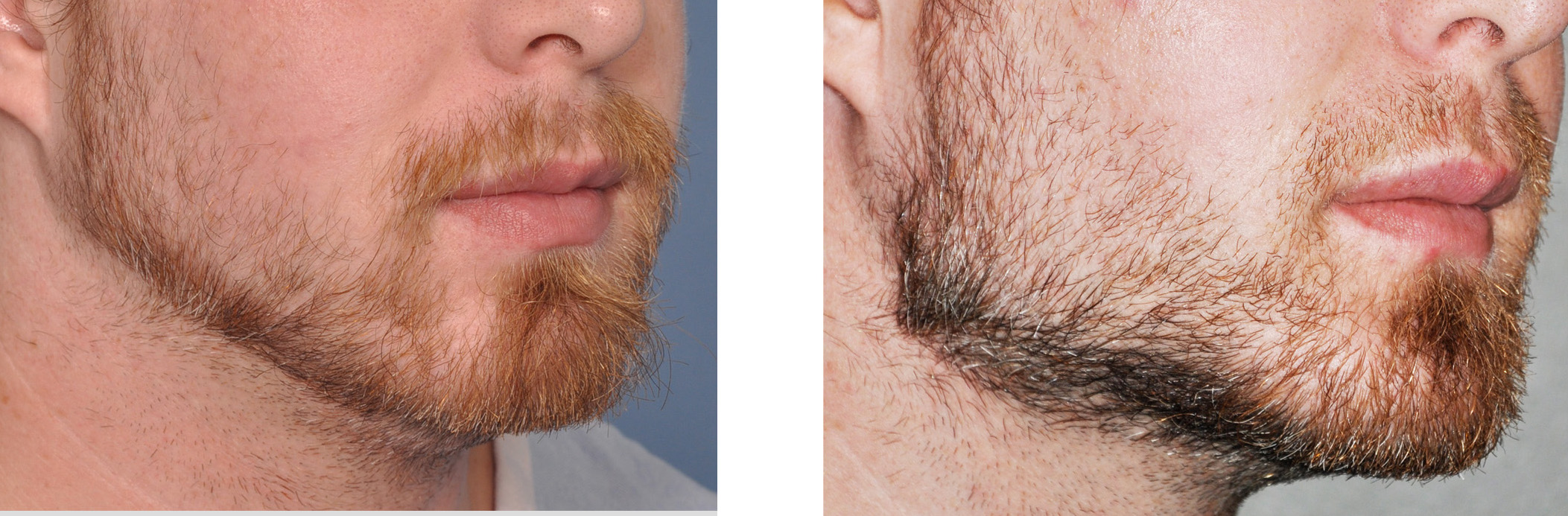 Custom-Chin-and-Jaw-Angle-Implants-right-oblique-view-Dr-Barry-Eppley-Indianapolis.jpg