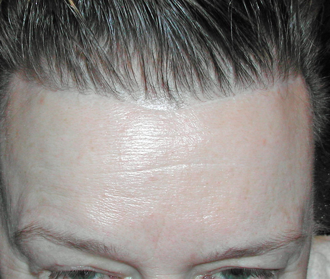 Pretrichial-Browlift-with-Forehead-reduction-scar-Dr-Barry-Eppley-Indianapolis.jpg