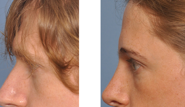Transgender-Brow-Bone-Reduction-result-side-view-Dr-Barry-Eppley-Indianapolis.jpg