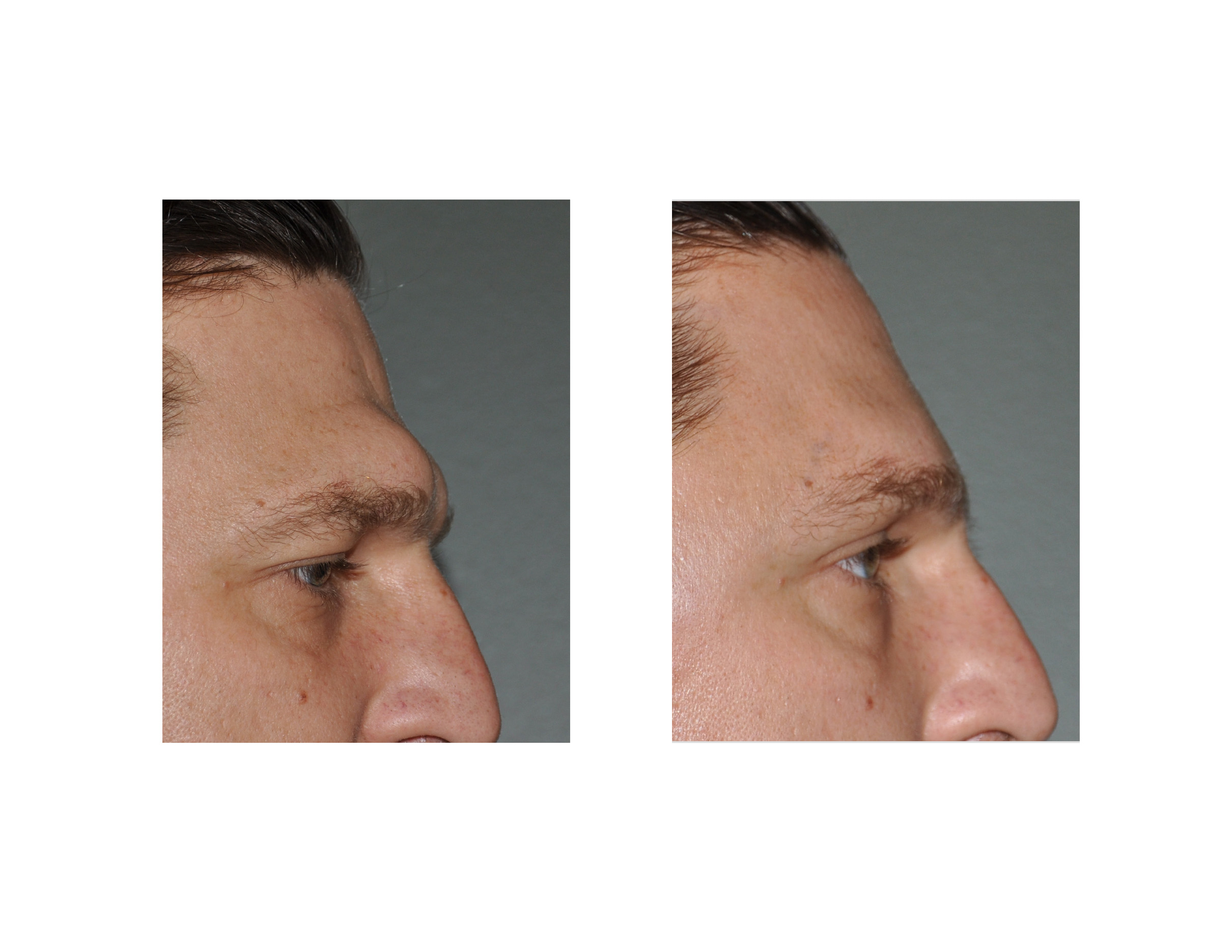 male-brow-bone-reduction-dr-barry-eppley-indianapolis.jpg