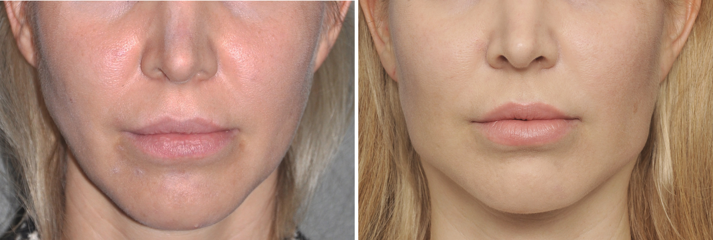 Female-Square-Jaw-Angle-Implants-result-frnt-view-Dr-Barry-Eppley-Indianapolis.jpg