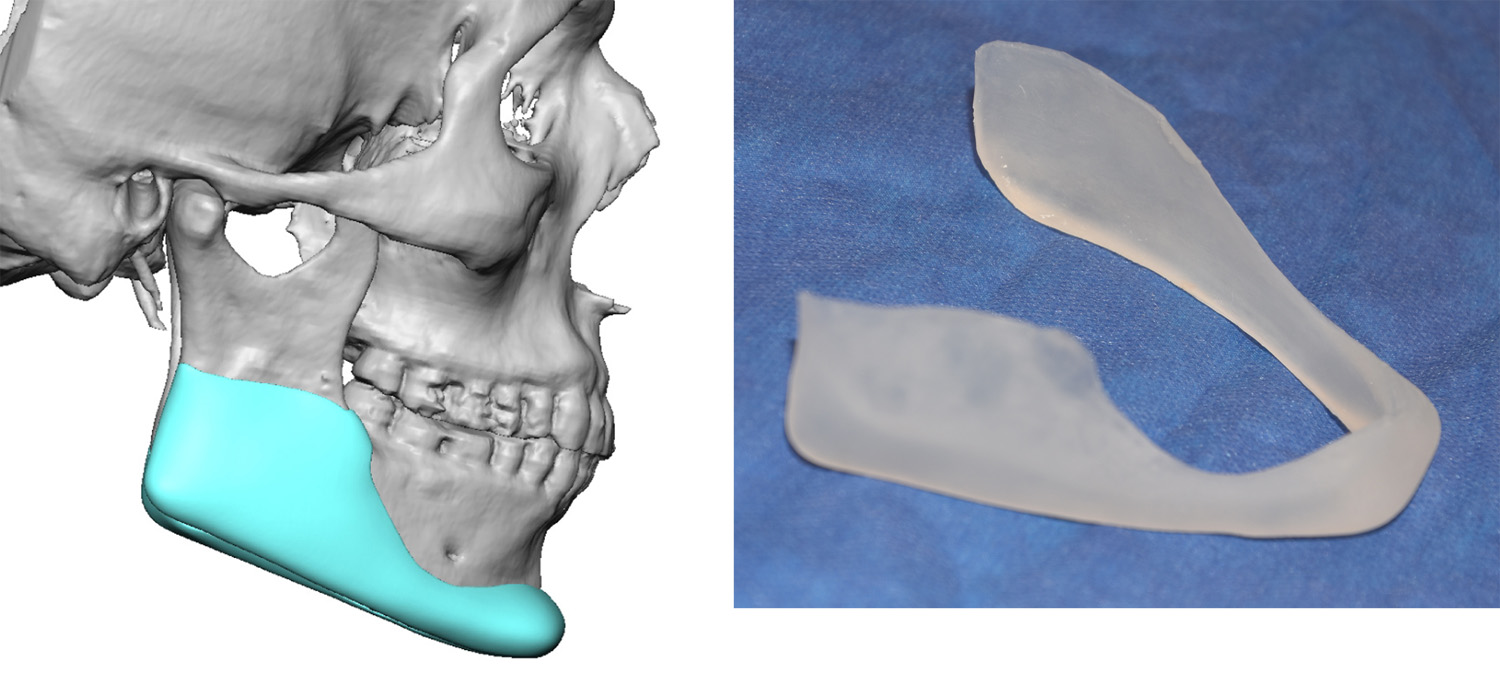 male-custom-jawline-implant-design-and-actual-implant-Dr-Barry-Eppley-Indianapolis.jpg
