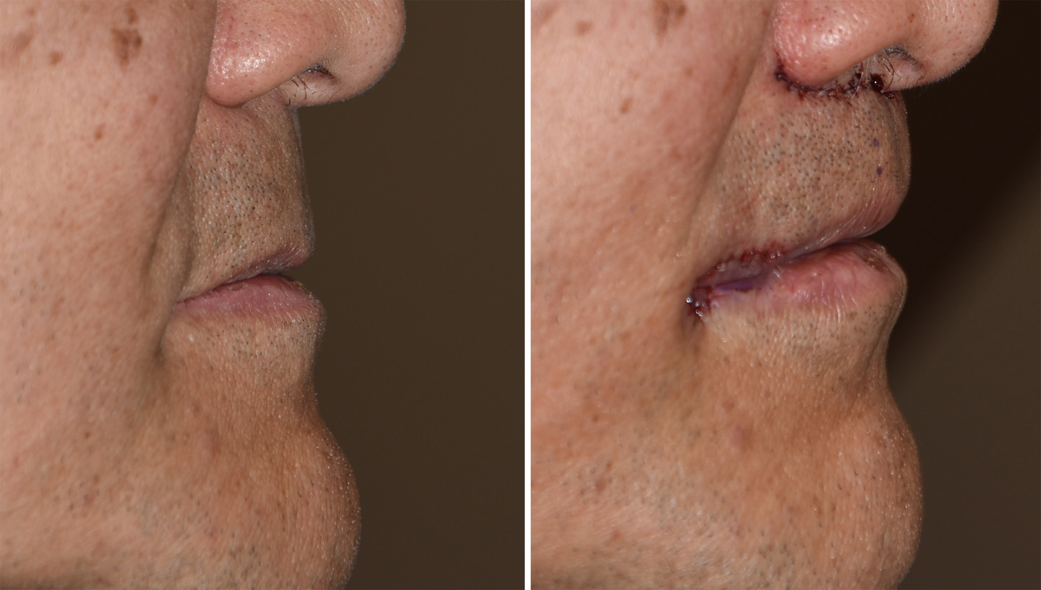 Subnasal-Lip-Lift-and-Corner-of-the-Mouth-Lifts-immediate-result-Dr-Barry-Eppley-Indianapolis.jpg