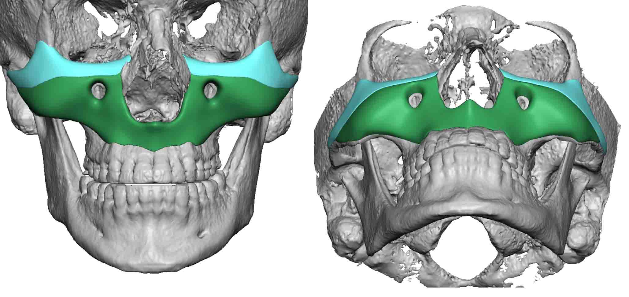Image result for custom paranasal implants