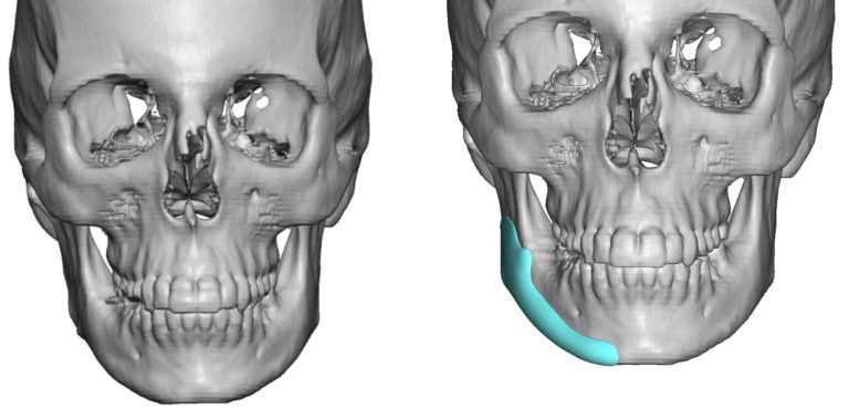 Custom-Right-Jawline-Implant-design-front-view-Dr-Barry-Eppley-Indianapolis-768x380.jpg