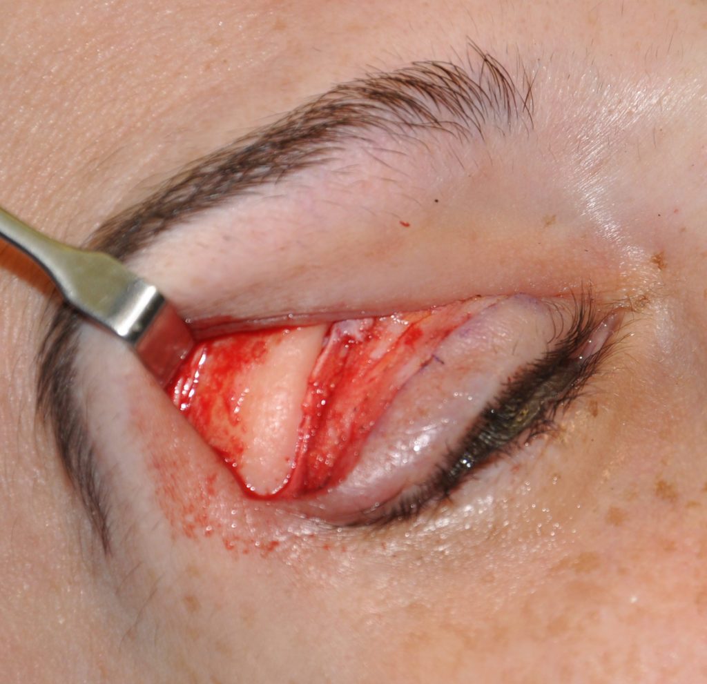 transpalpberal-lateral-brow-bone-reduction-intraop-Dr-Barry-Eppley-Indianapolis-1024x991-1024x991.jpg