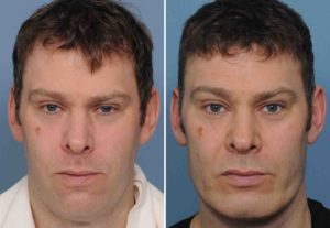 Male-Custom-Infraorbital-Malar-and-Jawline-Implant-results-front-view-Dr-Barry-Eppley-Indianapolis-300x207.jpg
