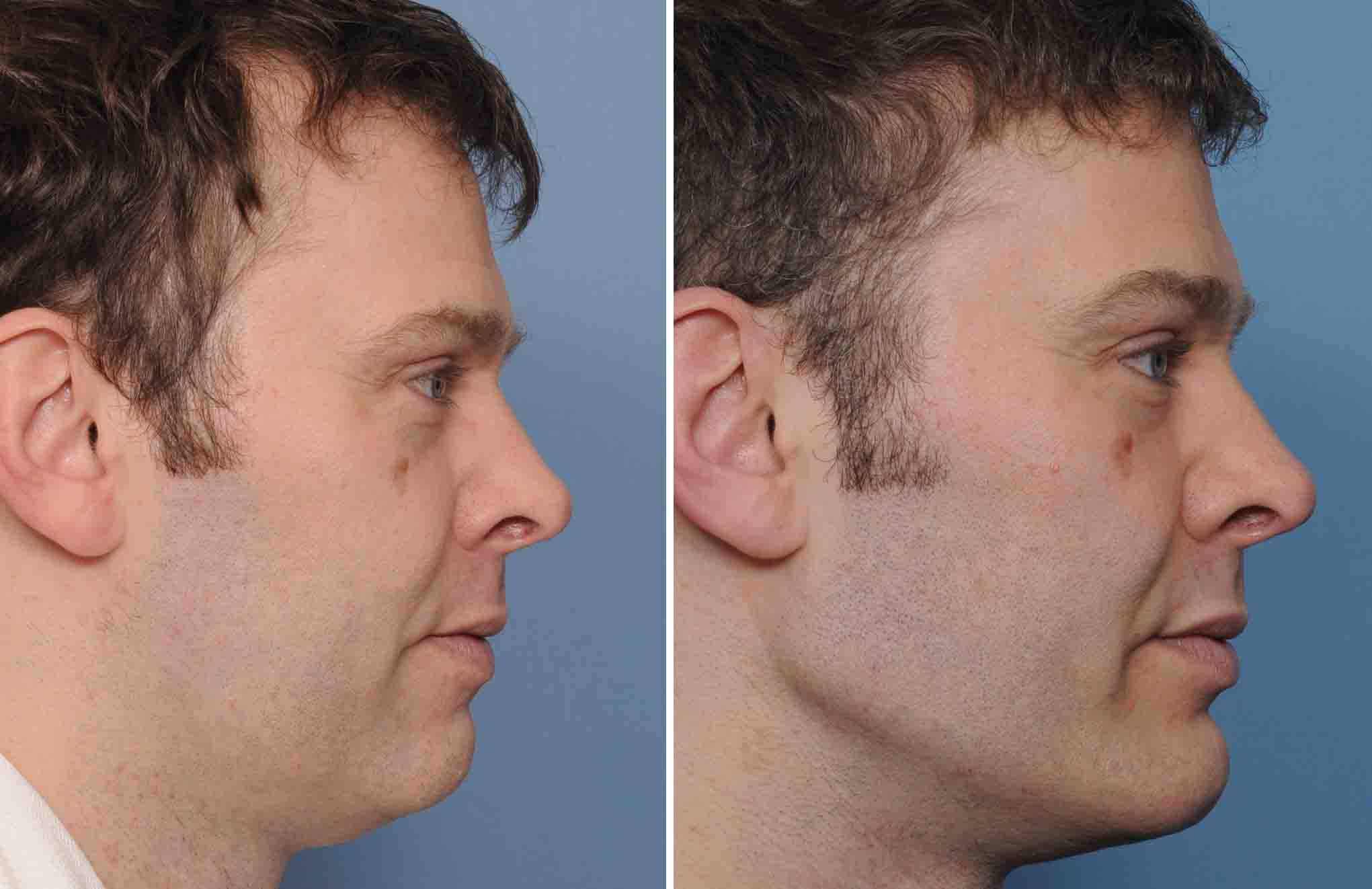 Male-Custom-Infraorbital-Malar-and-Jawline-Implant-results-side-view-Dr-Barry-Eppley-Indianapolis.jpg