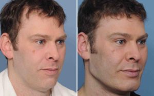Male-Custom-Infraorbital-and-Jawline-Implant-results-right-oblique-view-Dr-Barry-Eppley-Indianapolis-300x187.jpg