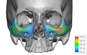 Custom-Infraorbital-Maxillary-Malar-Implants-thicknesses-color-mapping-Dr-Barry-Eppley-Indianapolis-300x189.jpg