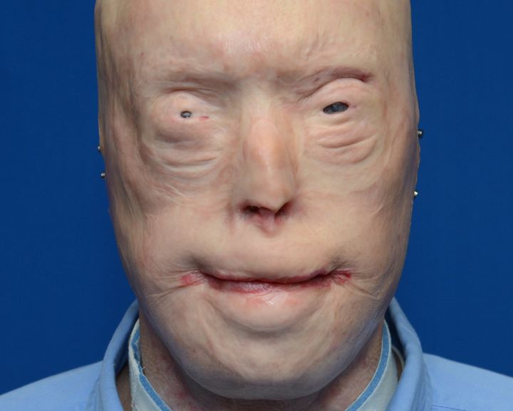 Graphic New Photos Of Face Transplant Show Burn Patient's Remarkable Rebirth | HuffPost