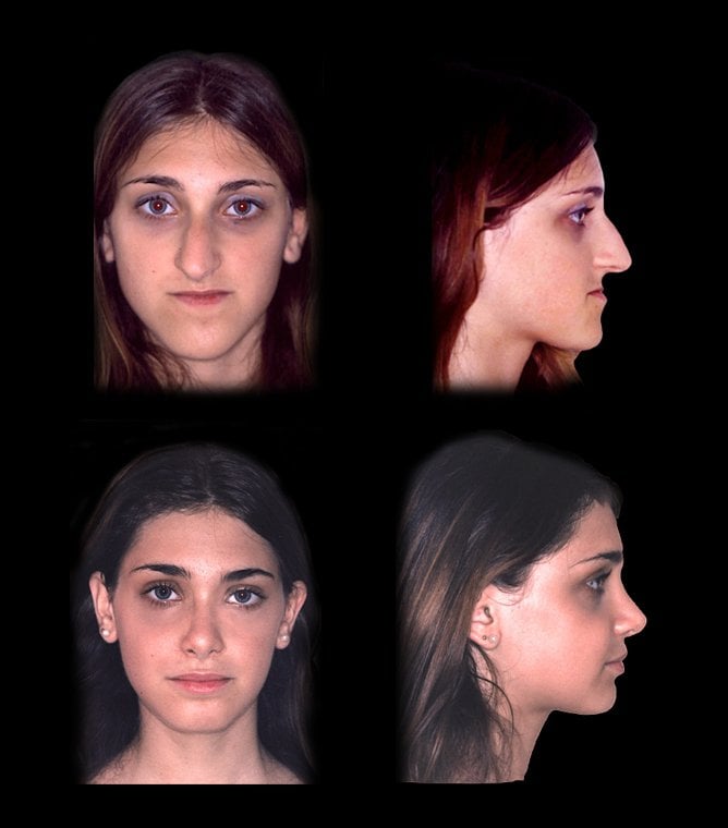Any experience with Plasticmaxxing? What does having rhinoplasty, jaw  surgery or breast implantscfeel like? : r/TheGlowUp