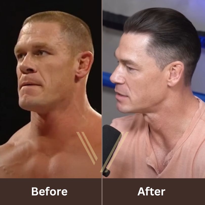 john-cena-hair-transplant-before-after.jpg