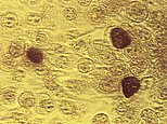 FILE - This 1975 file microscope image made available by the the Centers for Disease Control and Prevention shows chlamydia trachomatis bacteria magnified 200 times. U.S. infections from three sexually-transmitted diseases have risen for the fifth consecutive year and broken more records. More than 1.7 million cases of chlamydia were reported in 2018. (Dr. E. Arum, Dr. N. Jacobs/CDC via AP, File) FILE - This 1975 file microscope image made available by the the Centers for Disease Control and Prevention shows chlamydia trachomatis bacteria magnified 200 times. U.S. infections from three sexually-transmitted diseases have risen for the fifth consecutive year and broken more records. More than 1.7 million cases of chlamydia were reported in 2018. (Dr. E. Arum, Dr. N. Jacobs/CDC via AP, File)