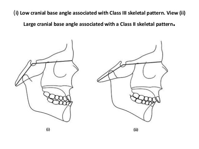 cranial-base-angle-in-relation-to-malocclusion-18-638.jpg