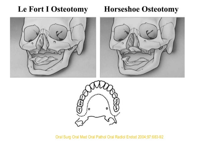 maxillary-orthognathic-surgery-33-638.jpg