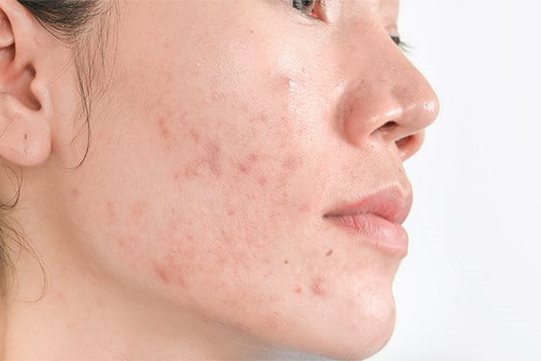 Hyperpigmentation | post-inflammatory hyperpigmentation | Eucerin Hyperpigmentation | post-inflammatory hyperpigmentation | Eucerin