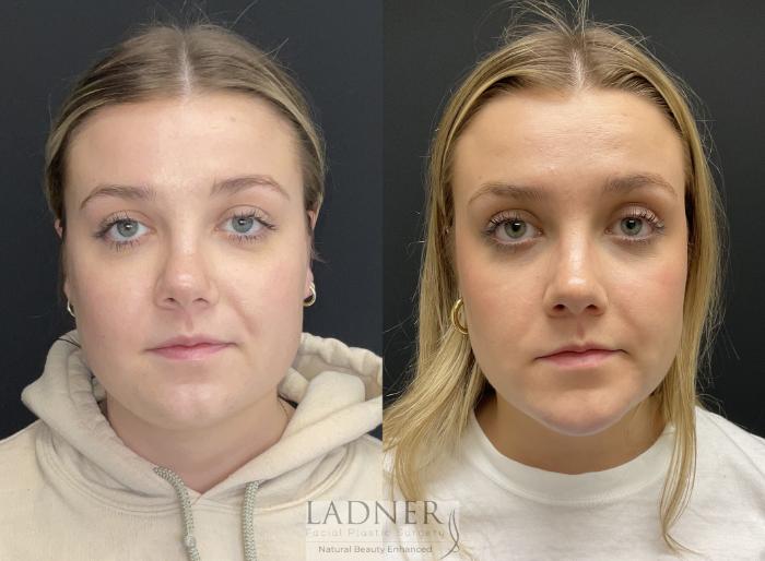 Buccal Fat Removal Before and After Photo Gallery | Denver, CO | Ladner  Facial Plastic Surgery