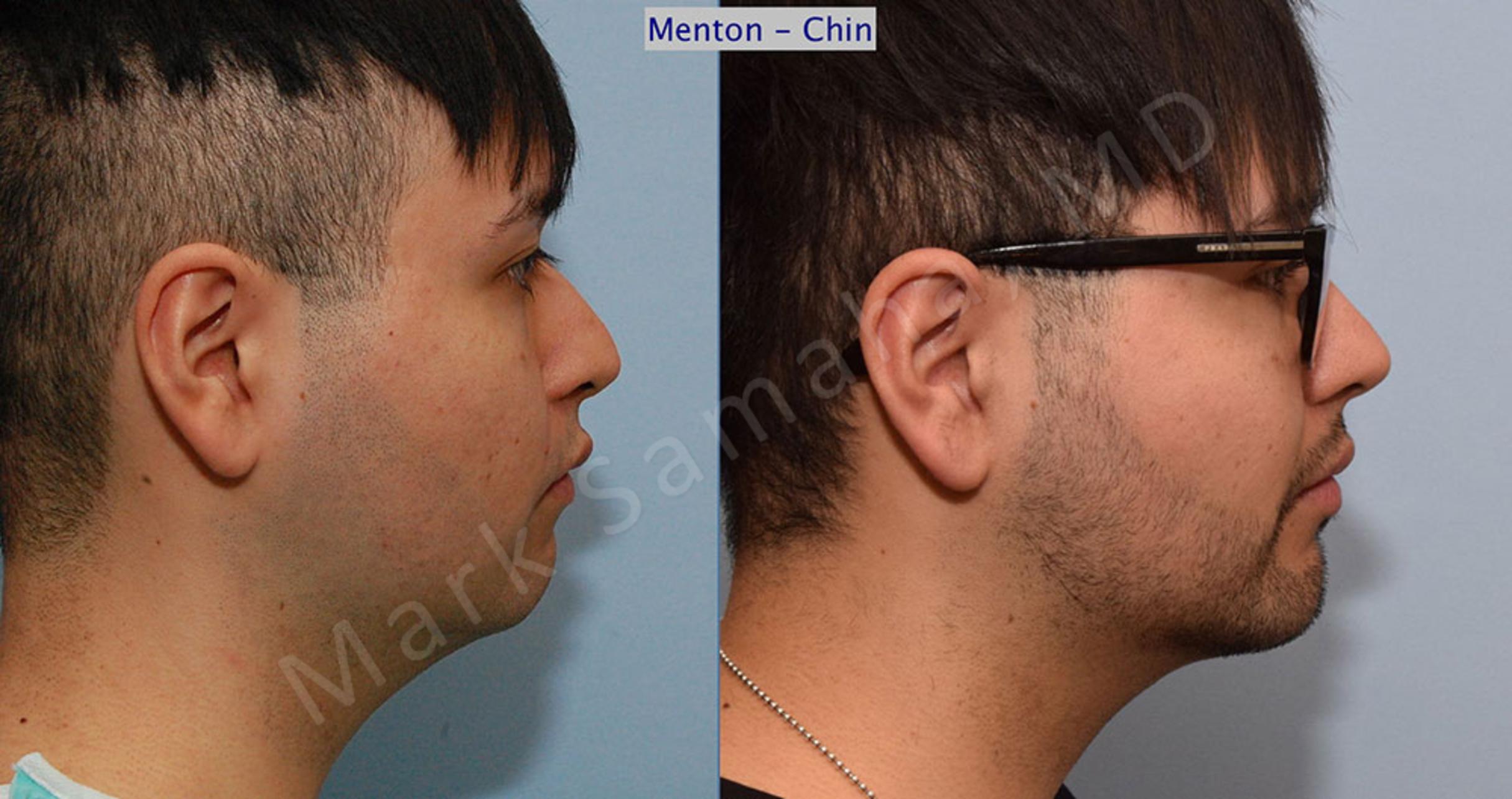 Chin Augmentation / Augmentation du menton Before and After Pictures Case 9  | Mount Royal, QC | Dr. Mark Samaha