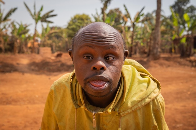 portrait-adult-bald-african-man-with-down-syndrome-forest-background_404612-375.jpg