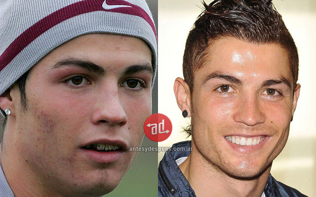 acne_Cristiano-Ronaldo_www.antesydespues.com.ar.jpg