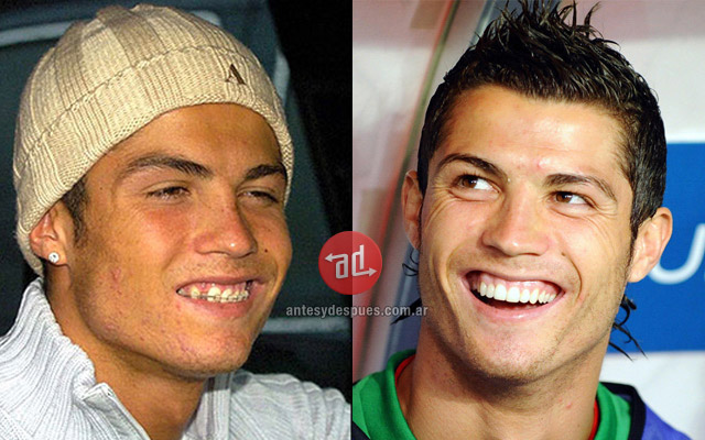 Cristiano-Ronaldo_teeth-before_www.beforeandafter.com.ar.jpg
