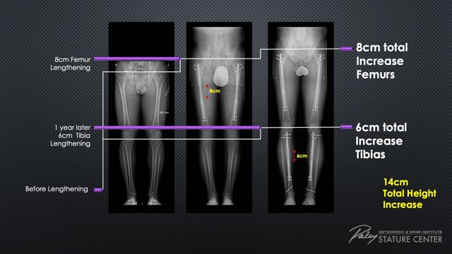 limblengthening.org