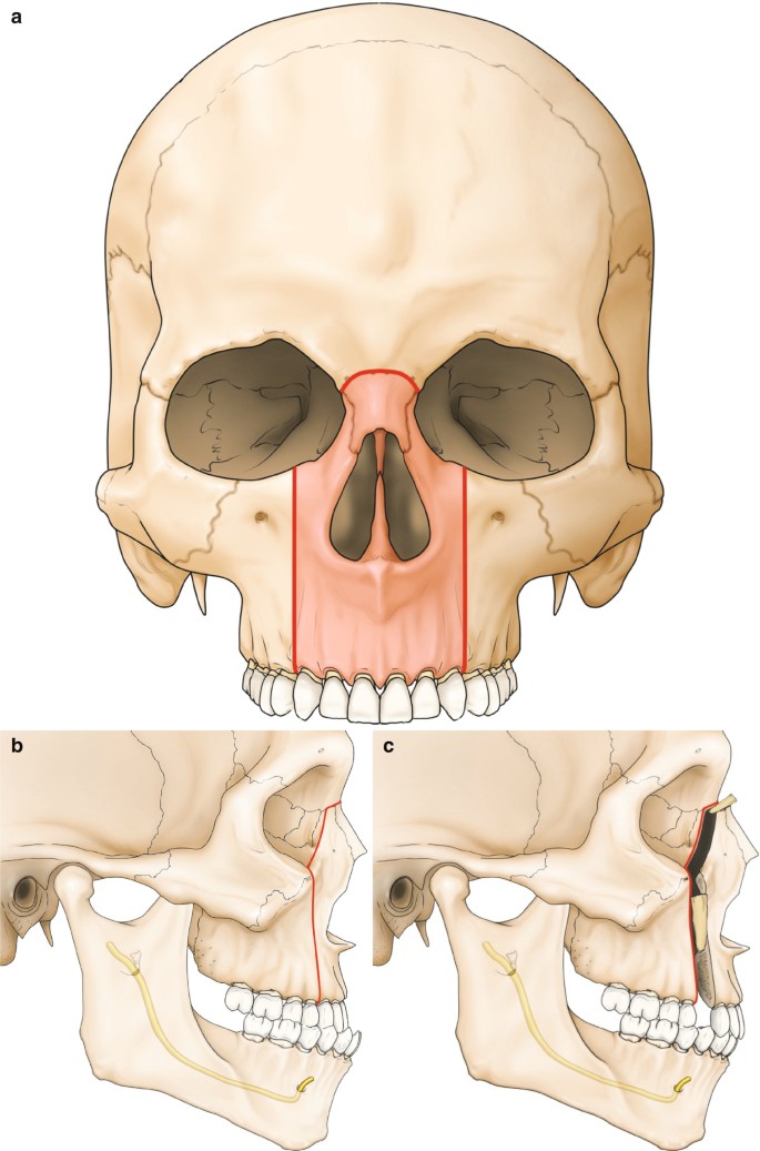 Le Fort II Osteotomy and Variations | SpringerLink Le Fort II Osteotomy and Variations | SpringerLink
