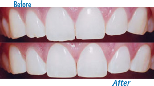 tooth-reshaping-and-dental-contouring-cost-in-india.png