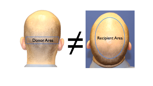 donor-area-and-recipient-area-mismatch-2.png