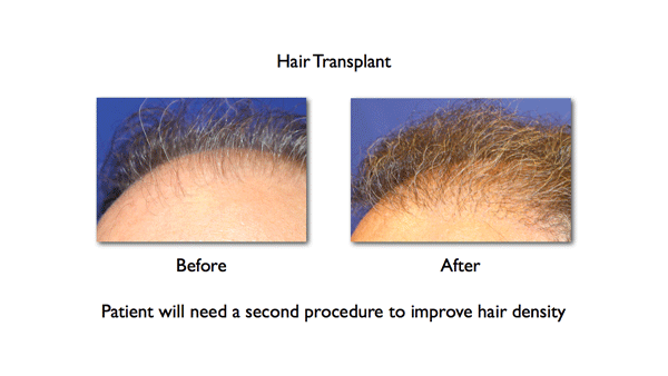 hair-density-after-1-hair-transplant-showing-the-need-for-a-second-hair-transplant-from-www_nyhairloss_com-for-Dr-Amiya-Prasad.png