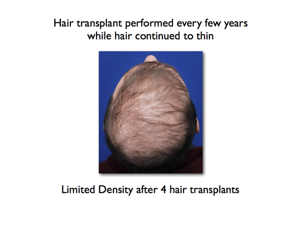 poor-density-after-several-hair-transplants-from-www_nyhairloss_com-for-Dr-Amiya-Prasad.png