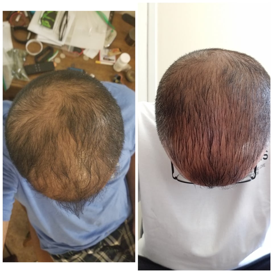 r/CBD - CBD and Hair Growth Follow Up - 2 months of using cbd oil on my hair daily. CBD seems to be working.