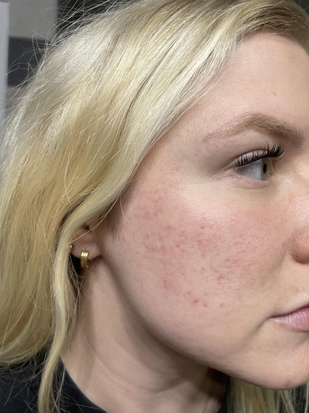 getting-rid-of-post-inflammatory-erythema-and-acne-scars-v0-u9jthx3n4uma1.jpg