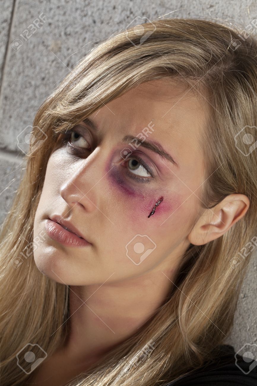 17377529-close-up-image-of-an-abused-woman-having-a-black-eye-and-wound-on-her-face.jpg