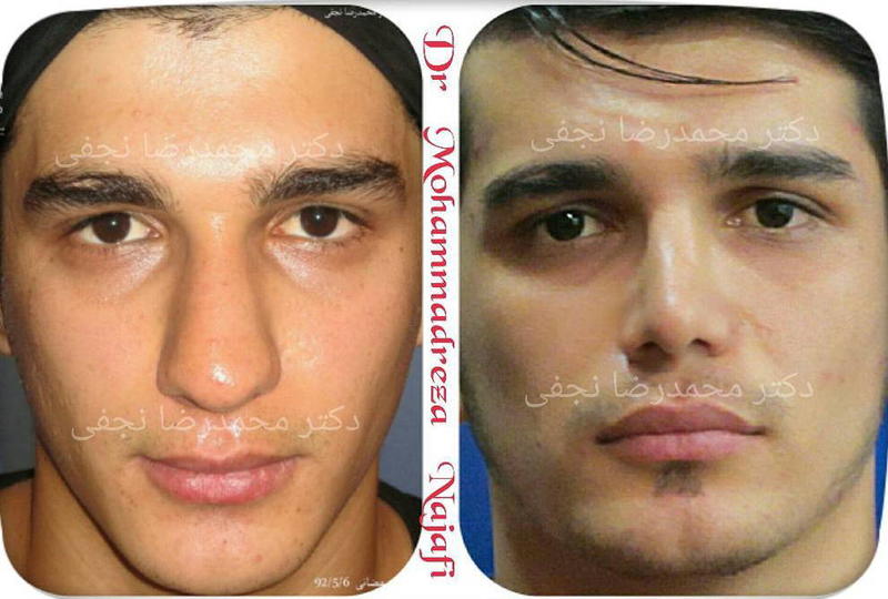 Male-Bulbous-Nose-Before-And-After-Nose-Surgery.jpg