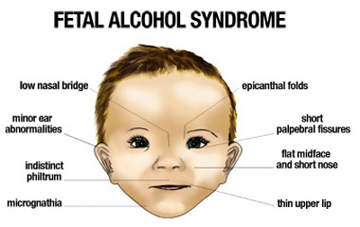 Fetal+alcohol+syndrome.jpg