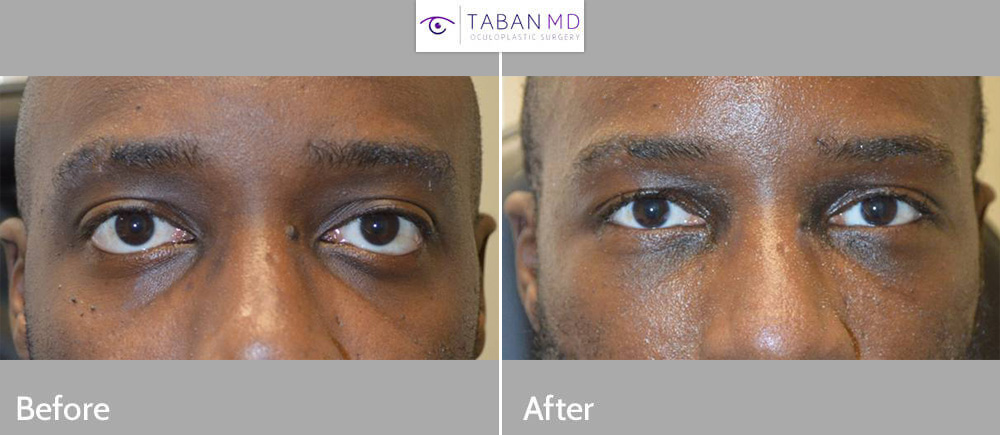 Infraorbital Rim Implant Before and After Photos | Taban MD Infraorbital Rim Implant Before and After Photos | Taban MD