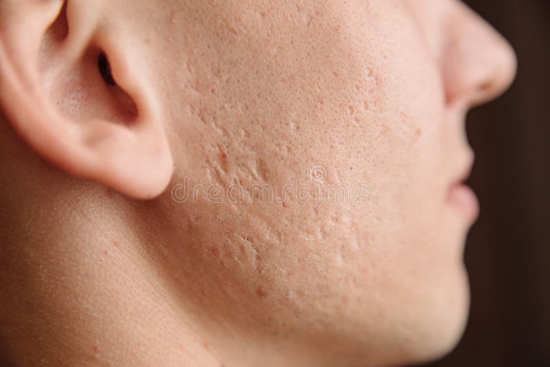 close-up-problem-skin-deep-acne-scars-young-man-s-cheek-acne-scars-face-180490179.jpg