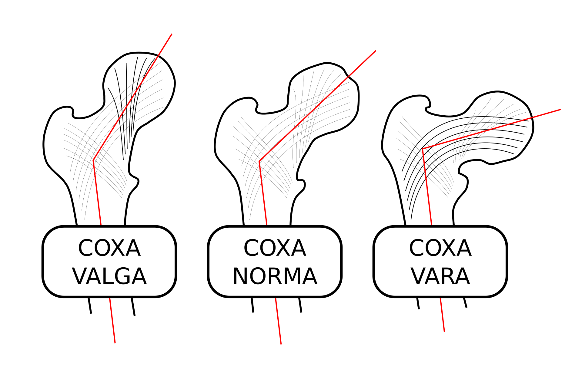 https://upload.wikimedia.org/wikipedia/commons/thumb/a/a4/Coxa-valga-norma-vara-000.svg/1920px-Coxa-valga-norma-vara-000.svg.png