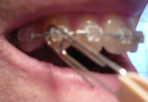 Attachment Site Attachment Site