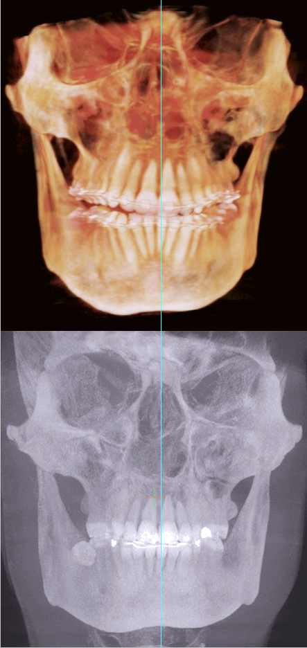 Jaw pain before-and-after FRONT VIEW Jaw pain before-and-after FRONT VIEW