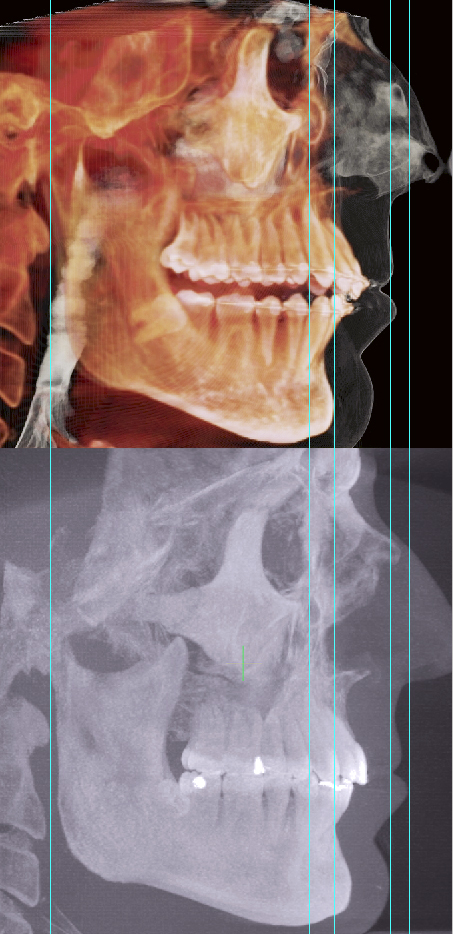 Jaw pain before-and-after SIDE VIEW Jaw pain before-and-after SIDE VIEW