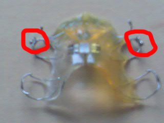 Modified Palate Expander  Modified Palate Expander